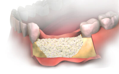 How Long Do Stitches Last After Gum Graft Surgery?